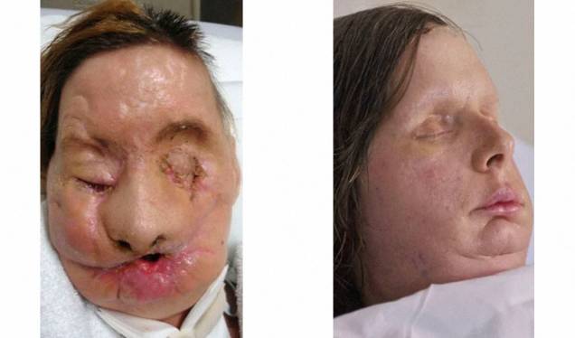 Antes e depois da paciente Charla Nash, que fez o transplante em 2011 Antes e depois da paciente Charla Nash, que fez o transplante em 2011