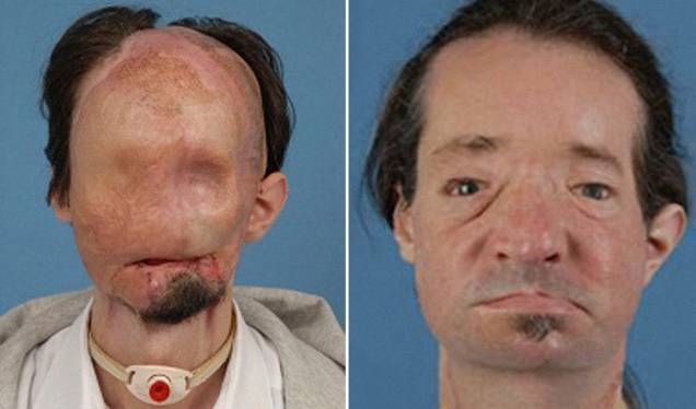 Antes e depois do paciente Dallas Wiens, que fez o transplante em 2011 Antes e depois do paciente Dallas Wiens, que fez o transplante em 2011
