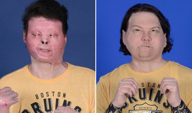 Antes e depois do paciente Joe DiMeo, que fez o transplante em 2021 Antes e depois do paciente Joe DiMeo, que fez o transplante em 2021
