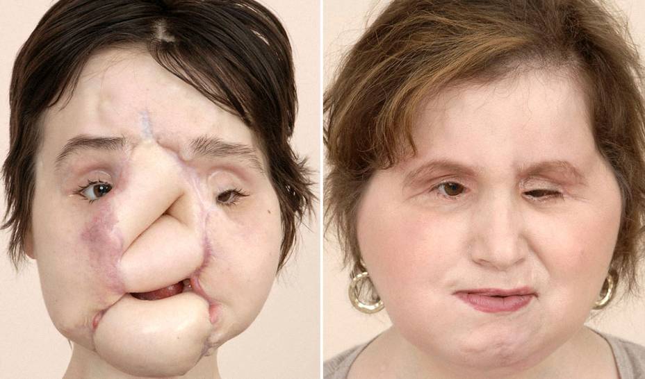Antes e depois da paciente Katie Stubblefield, que passou pelo transplante em 2017