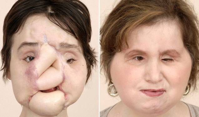 Antes e depois da paciente Katie Stubblefield, que passou pelo transplante em 2017 Antes e depois da paciente Katie Stubblefield, que passou pelo transplante em 2017
