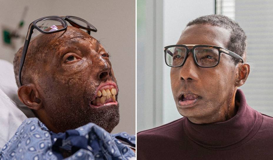 Antes e depois do paciente Robert Chelsea, que passou pelo transplante em 2019