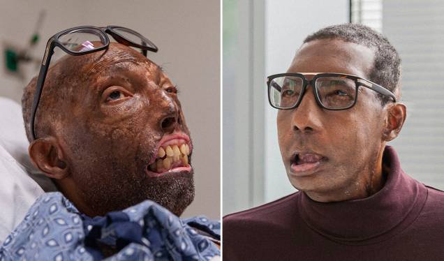 Antes e depois do paciente Robert Chelsea, que passou pelo transplante em 2019 Antes e depois do paciente Robert Chelsea, que passou pelo transplante em 2019