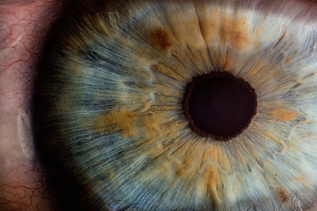 Como funciona a cirurgia para mudar a cor dos olhos?