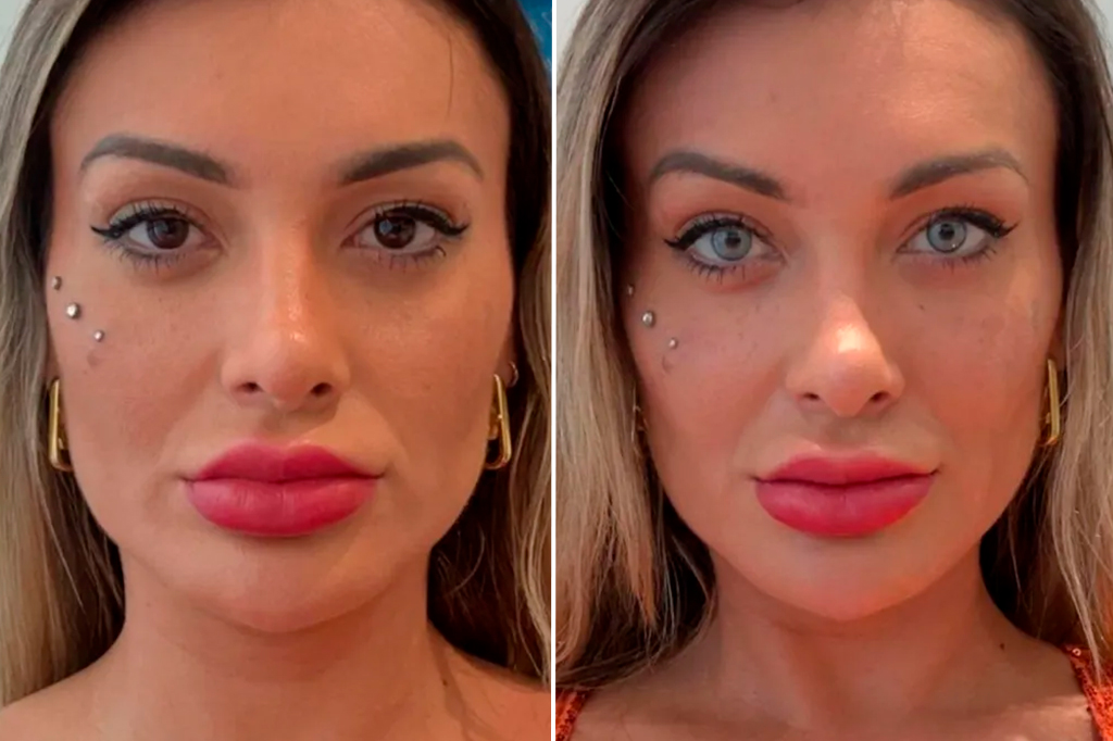 2806-OLHO-AZUL-layout_site1 Fotografia do antes e depois da cirurgia da Andressa Urach.