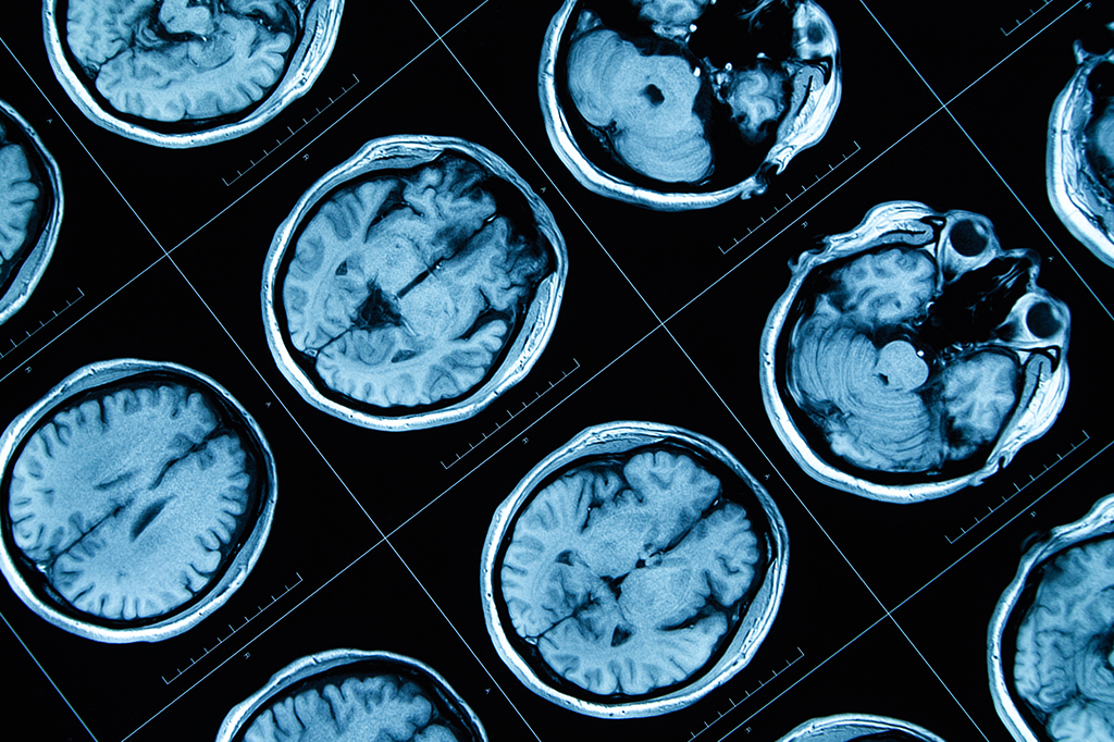 Pandemia envelheceu o cérebro até de quem não teve Covid-19, indica estudo