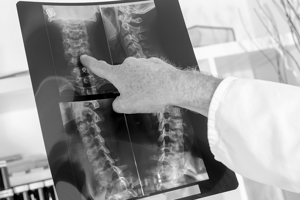 Como funciona o medicamento brasileiro que pode ajudar a recuperar movimentos após lesões na medula