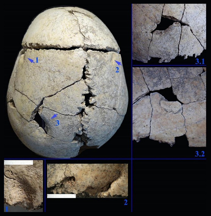 Imagem das les&otilde;es &oacute;sseas encontradas na calota craniana.