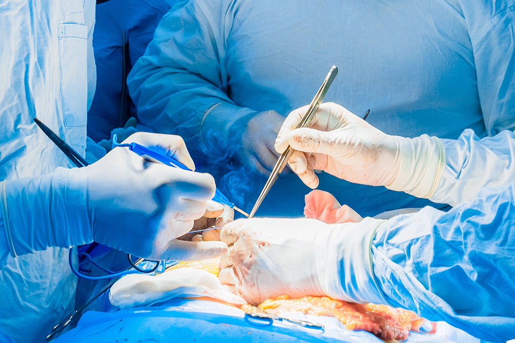 Fotografia de uma equipe de cirurgiões com instrumentos cirúrgicos realizam cirurgia.