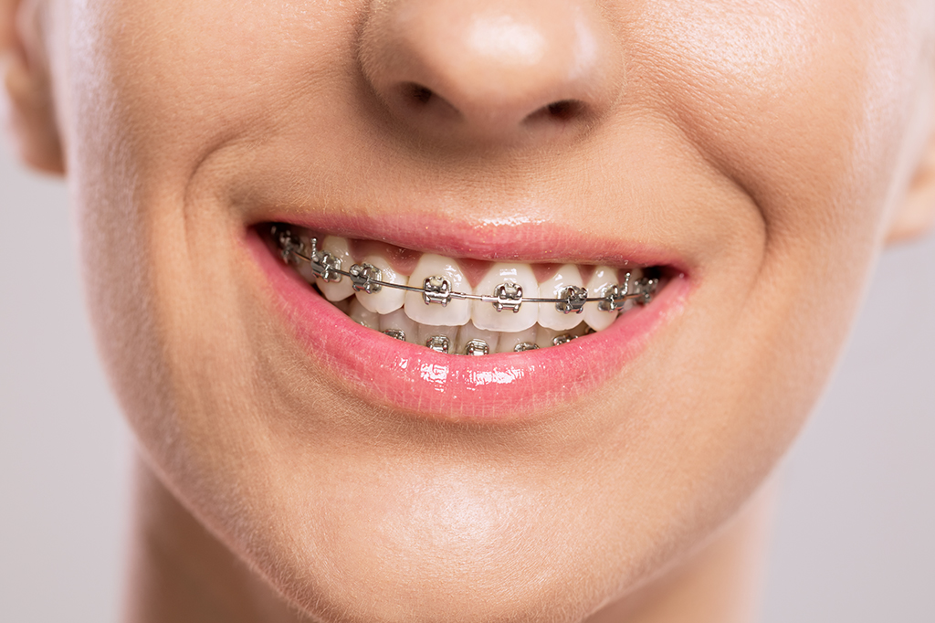 Fotografia de uma pessoa de aparelho sorrindo.