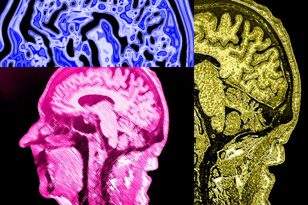 Montagem de um exame cerebral mostrando demência/Alzheimer em estágio inicial.