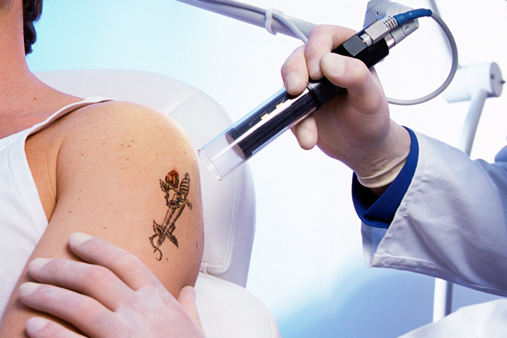 Para onde vai a tinta da tatuagem removida a laser?