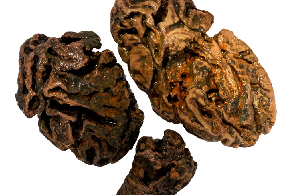 Fragmentos de cérebro de um indivíduo enterrado em um cemitério de um asilo para pobres da era vitoriana. Todos com um tom marrom-avermelhado, sobre um fundo branco.